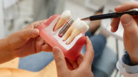Dental Implants