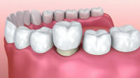 Dental Crowns