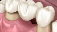 Dental Bridges and Crowns
