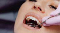 Composite Fillings