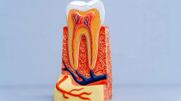 Root Canal