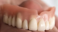 Dental Dentures