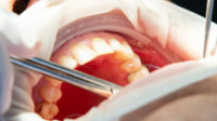 Root Canal Therapy