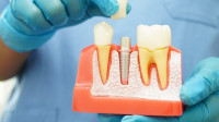 Dental Implants