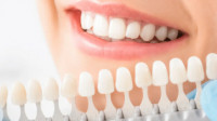 Dental Crowns