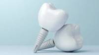 Dental Implants Restoration in Beverly Hills, CA