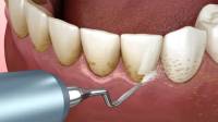 Teeth Cleaning (Prophy) in Beverly Hills, CA