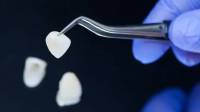 Dental Veneers in Westwood, CA