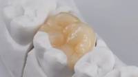 Dental Crowns in Westwood, CA