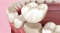Dental Crowns