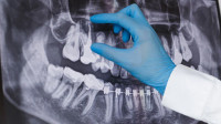 Root Canal Therapy