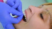Porcelain Veneers