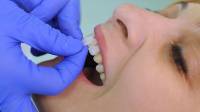 Porcelain Veneers