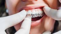 Invisalign Clear Aligners