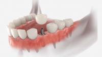 Single-Tooth Implant