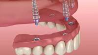 All-on-4 Dental Implants