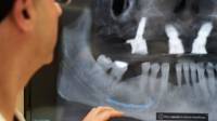 Snap-in Dentures