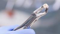 Tooth Extraction