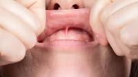 Frenectomy Treatment