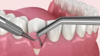Gum Graft Surgery