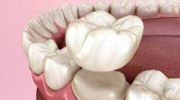 Dental Crowns