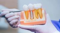 Dental Implants