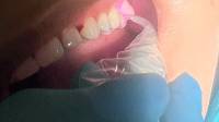 Laser Dentistry