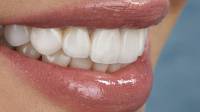 Dental Veneers