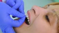 Veneers