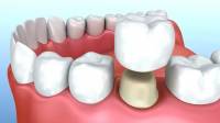 Dental Crowns