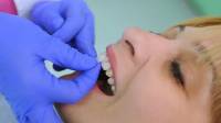 Porcelain Veneers