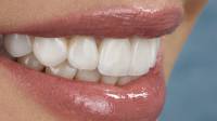 Dental Veneers