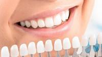 Teeth Whitening