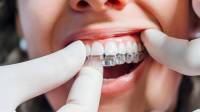 Invisalign Clear Aligners