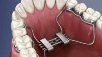 Palatal Expanders