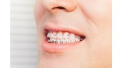 Traditional Braces