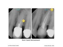 Root Canal Treatment - before and after