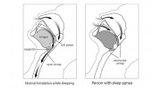 Sleep Apnea Treatment