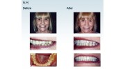 Stunning Smile Makeover Veneers