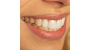 Halitosis & Fresh Breath