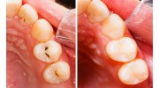 Dental Fillings