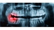 Wisdom Teeth Removal