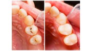 Tooth Colored Fillings