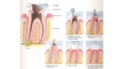 Root canals