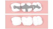 Composite Fillings