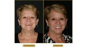 Custom Made Dentures