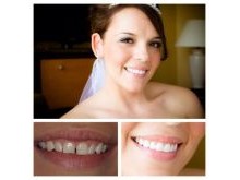 Veneers case - before and after