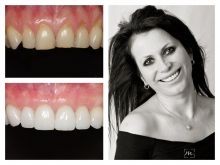 Veneers case - before and after