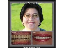 Porcelain Crowns - before and after