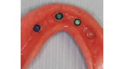 Implants Dentistry, Tooth Replacement Dental Treatment